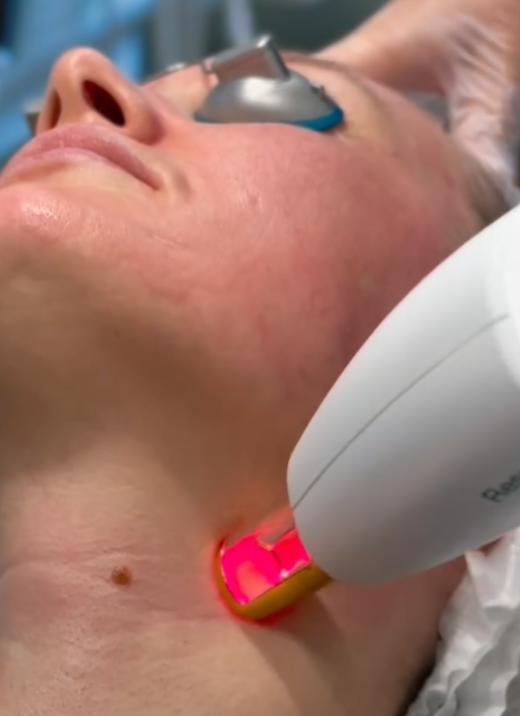 Lumenis Stellar M22 laser device inside the treatment room at SVIT Aesthetics, used for IPL and ResurFX skin rejuvenation.