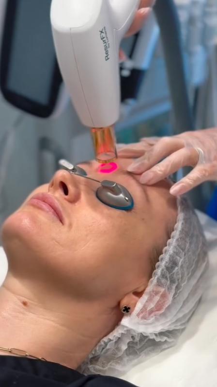 Lumenis Stellar M22 laser device inside the treatment room at SVIT Aesthetics, used for IPL and ResurFX skin rejuvenation.