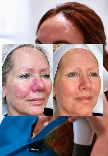 Before-and-after comparison illustrating improvements in skin texture and redness following non-ablative laser resurfacing treatments such as ResurFX at a medical aesthetics practice in Southlake, Texas.