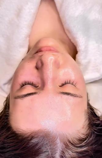 Patient resting after a non-ablative laser skin resurfacing treatment, showing mild post-treatment redness consistent with ResurFX recovery at a medical aesthetics practice in Southlake, Texas.