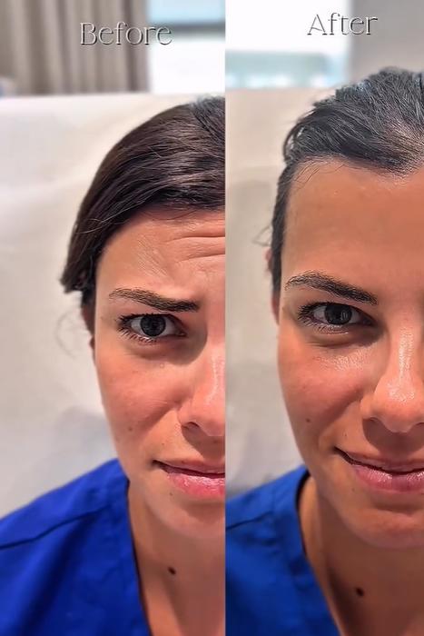 Before and after comparison showing improvement in facial firmness and contour at SVIT Aesthetics in Southlake