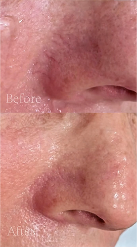 Before and after IPL photofacial treatment using the Lumenis Stellar M22™ laser to improve the appearance of facial redness in Southlake