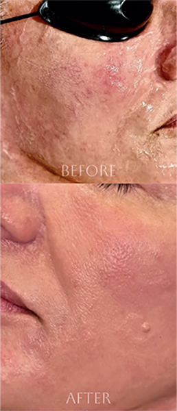Before and after IPL photofacial treatment using the Lumenis Stellar M22™ laser in Southlake