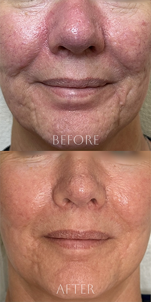 Before and after ResurFX™ non-ablative fractional laser resurfacing treatment using the Lumenis Stellar M22™ platform in Southlake