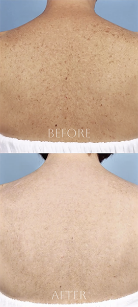 Before and after photofractional laser treatment combining IPL and ResurFX™ with the Lumenis Stellar M22™ platform in Southlake