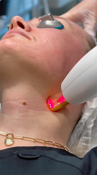 IPL photofacial treatment performed on the neck using the Lumenis Stellar M22™ laser in Southlake