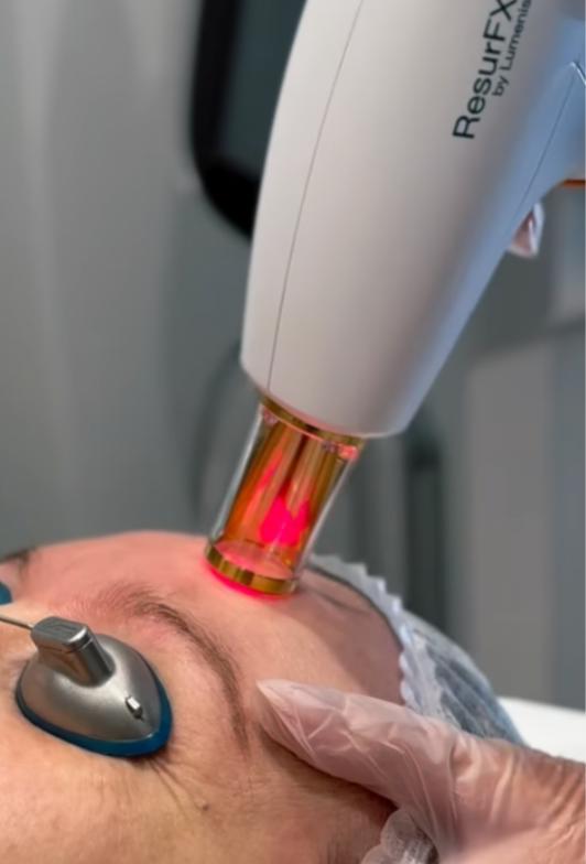 Stellar M22 IPL handpiece used for photofacial skin tone treatments at SVIT Aesthetics in Southlake