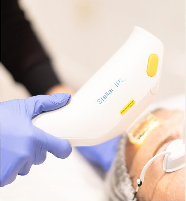 IPL photofacial treatment using the Stellar M22 device at SVIT Aesthetics in Southlake