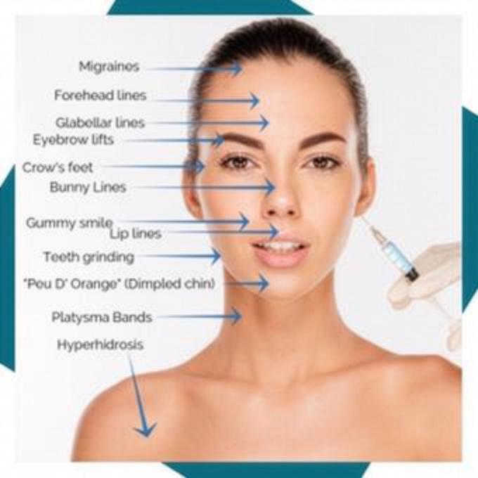 Common cosmetic treatment areas for Botox and Dysport in Southlake TX including forehead lines and crow’s feet.