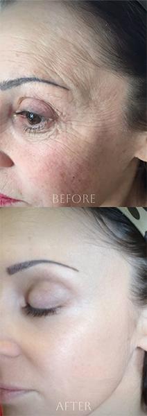 Before and after injectable skin treatment in Southlake TX showing improved texture and radiance.