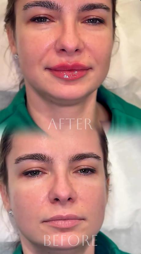 Before and after lip enhancement using European technique in Southlake TX showing natural shape and definition.
