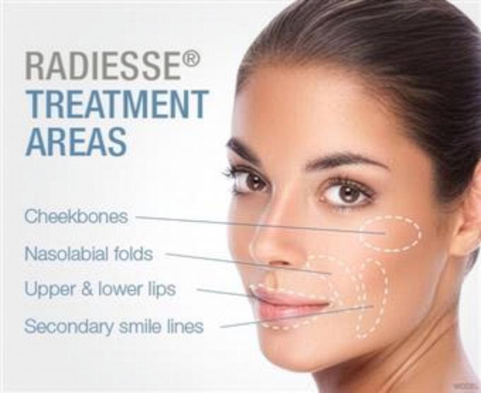 Radiesse treatment areas for facial contour and volume support in Southlake TX.