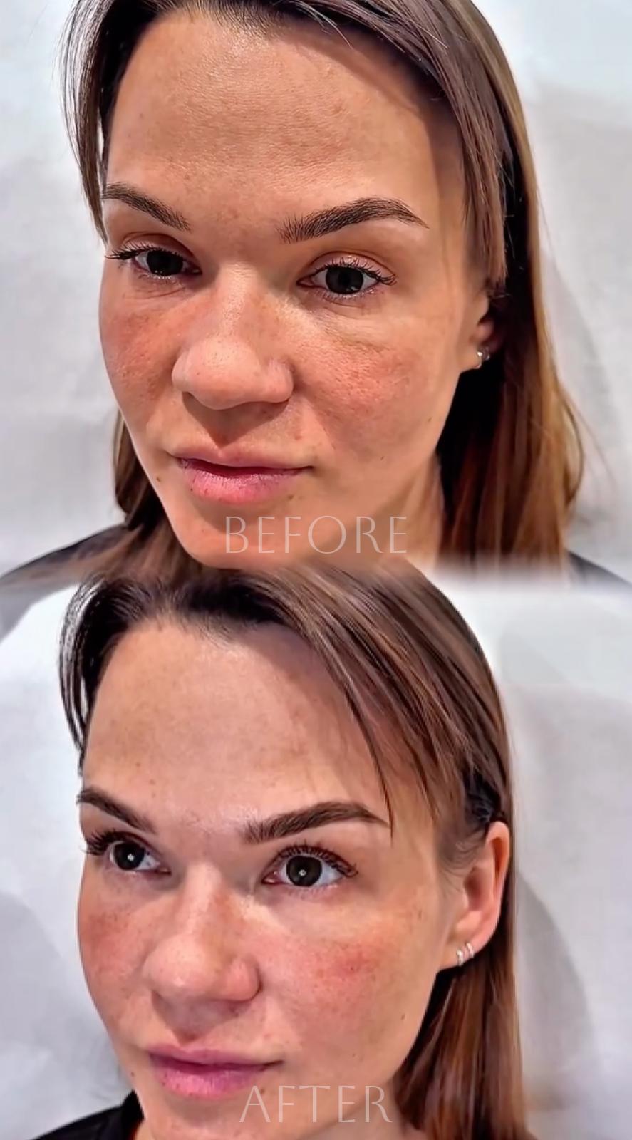 Before and after under-eye injectable treatment in Southlake TX showing improved appearance and smoother-looking skin.