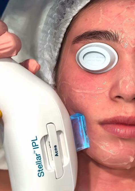 Lumenis Stellar M22 laser device inside the treatment room at SVIT Aesthetics, used for IPL and ResurFX skin rejuvenation.