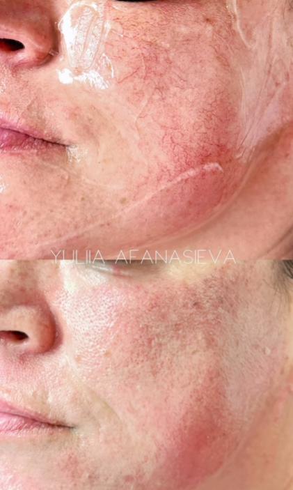 Close-up before and after images showing smoother skin texture and reduced roughness after ResurFX fractional laser treatment.
