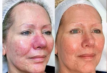 Before-and-after comparison illustrating improvements in skin texture and redness following non-ablative laser resurfacing treatments such as ResurFX at a medical aesthetics practice in Southlake, Texas.