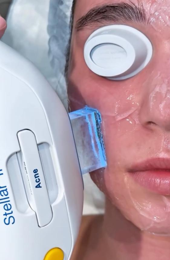 Patient receiving an IPL photofacial treatment with the Lumenis Stellar M22 device at SVIT Aesthetics to help improve the appearance of skin tone and clarity.