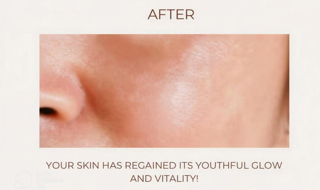 Close-up after image of facial skin showing a smoother, brighter and more radiant appearance following a HydraFacial treatment.