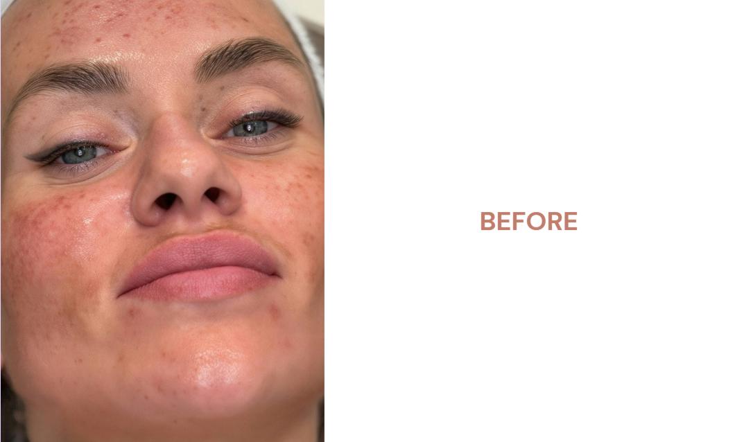 Close-up before image of a client’s face showing visible redness, uneven texture and blemish marks before a cosmetic peel treatment.