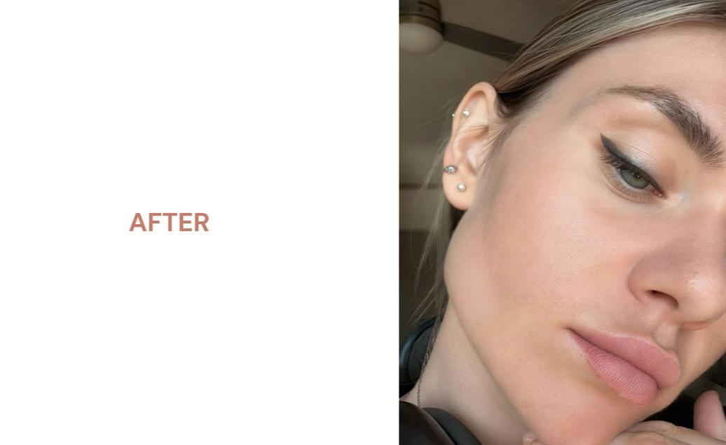 Close-up after image of a client’s face showing a calmer, smoother-looking complexion following a cosmetic peel treatment.