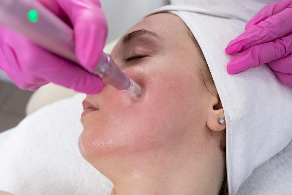 Microneedling with Exosomes vs. PRP — What Is the Difference, and When Does the Switch Make Sense?