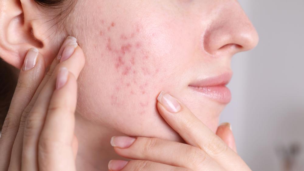 Acne-Prone Skin in Southlake: A Guide to Aesthetic Options Beyond a Basic Facial