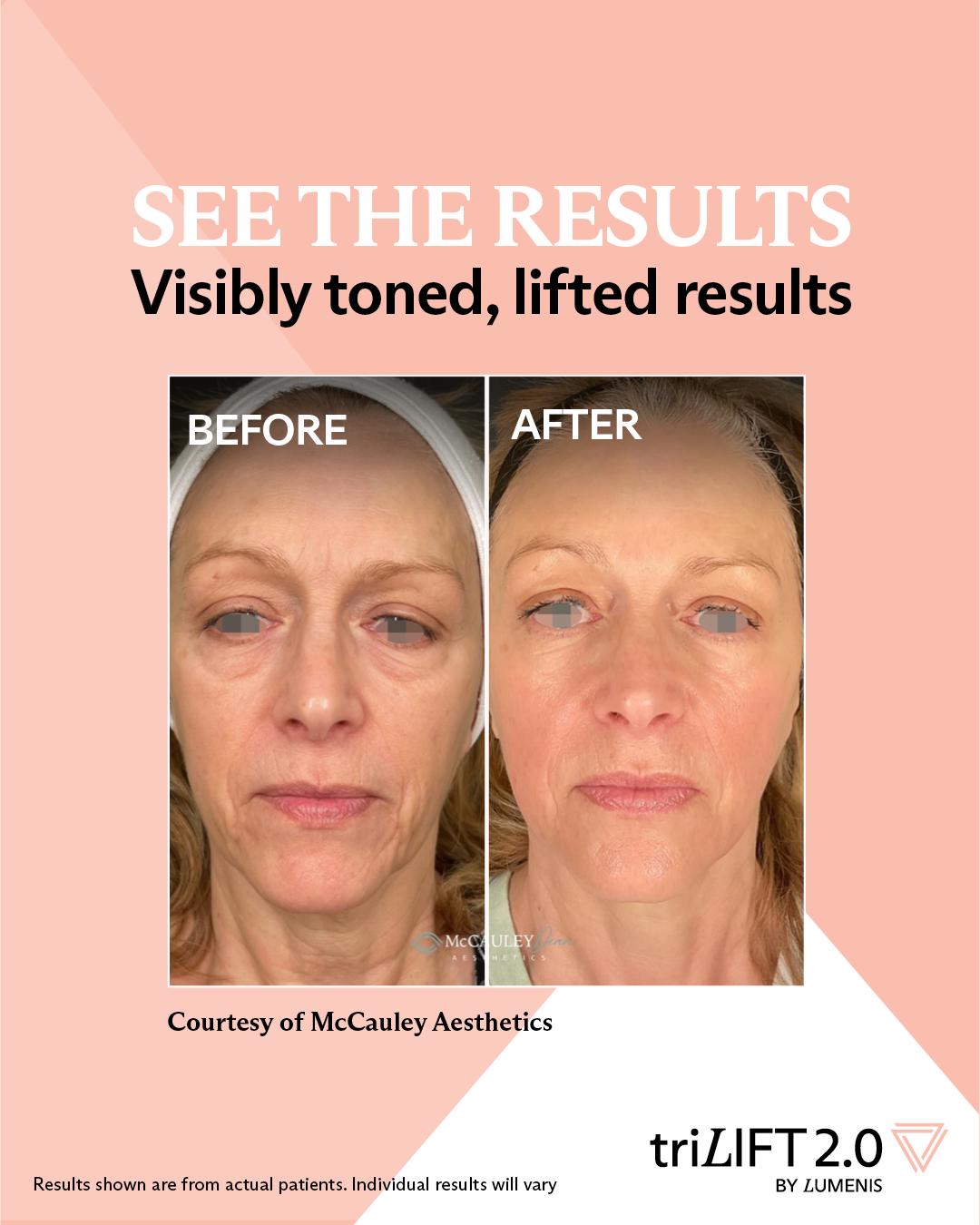 Before and after appearance comparison following triLIFT 2.0 facial treatment — individual results vary